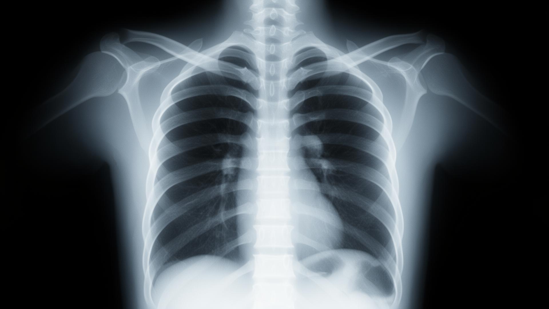 A chest X-ray on a lightbox with a small region circled in cyan, dark room